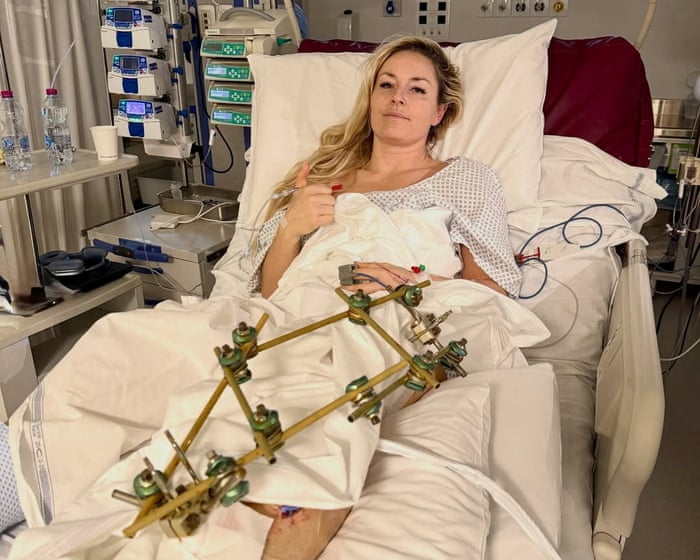 Lindsey Vonn muvaffaqiyatli jarrohlik amaliyotini o'tkazdi